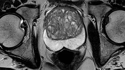 Urología en Madrid, Andrología, Disfuncion Erectil, Dr. Luis Fiter