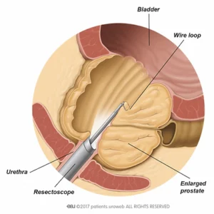 Urología en Madrid, Andrología, Disfuncion Erectil, Dr. Luis Fiter