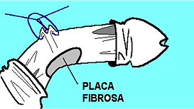 Urología en Madrid, Andrología, Disfuncion Erectil, Dr. Luis Fiter